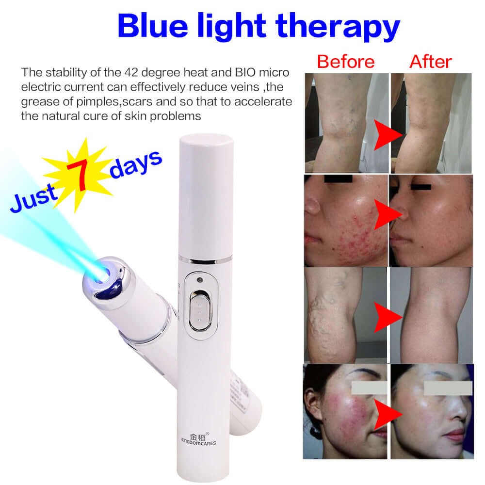 Magic Blue Light Facial Machine for Acne, Wrinkles, and Spider Veins Removal - All-Gadgetry