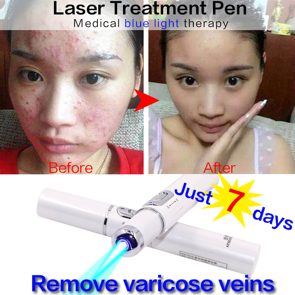 Magic Blue Light Facial Machine for Acne, Wrinkles, and Spider Veins Removal - All-Gadgetry