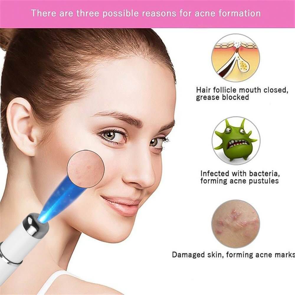 Magic Blue Light Facial Machine for Acne, Wrinkles, and Spider Veins Removal - All - Gadgetry