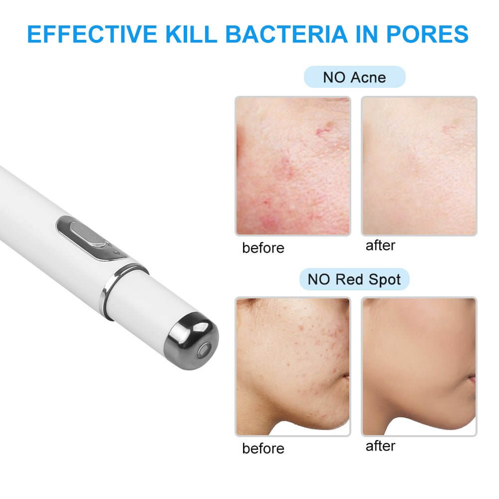 Magic Blue Light Facial Machine for Acne, Wrinkles, and Spider Veins Removal - All - Gadgetry