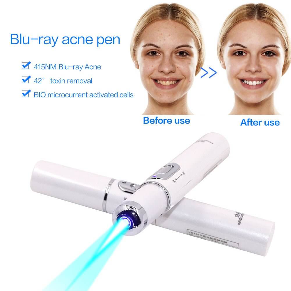 Magic Blue Light Facial Machine for Acne, Wrinkles, and Spider Veins Removal - All - Gadgetry